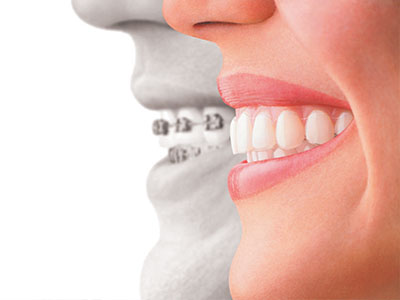 Image depicts a split-screen comparison of a person s natural teeth and a dental implant, with the implant appearing as an overlay on the original teeth.