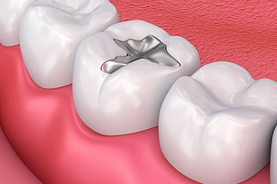 The image depicts a close-up of a human dental implant, which is a metallic screw-like piece inserted into the jawbone to replace a missing tooth.