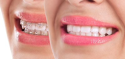 The image shows a close-up of a person s smiling face, with the focus on their teeth and lips.