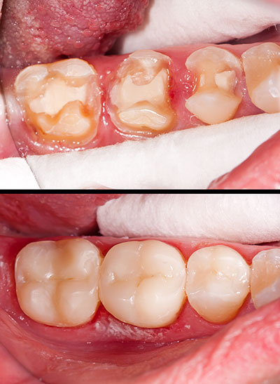 The image shows a close-up of a person s mouth with teeth that appear to be in poor condition, likely due to decay or gum disease.