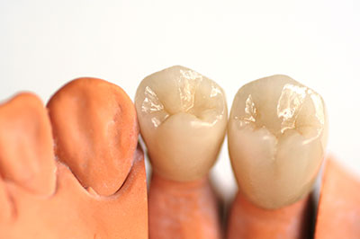 The image shows a set of artificial teeth with different shades and textures, likely used for dental implant demonstration or educational purposes.