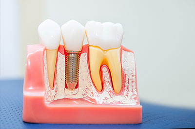 An image of a dental model with artificial teeth and gums, showcasing a toothpaste dispenser mechanism within the mouthpiece.