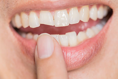 The image shows a person with a wide smile, revealing teeth and holding their finger near the teeth.