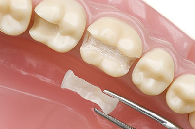 The image shows a close-up of a tooth with a filling being placed, with dental tools visible in the process.