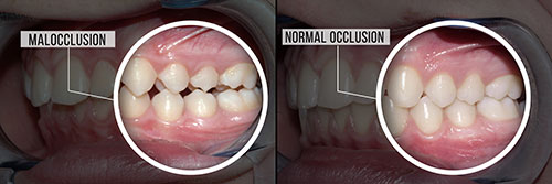 The image shows a side-by-side comparison of a person s teeth before and after orthodontic treatment, with the  before  showing crooked teeth and the  after  displaying straightened teeth.