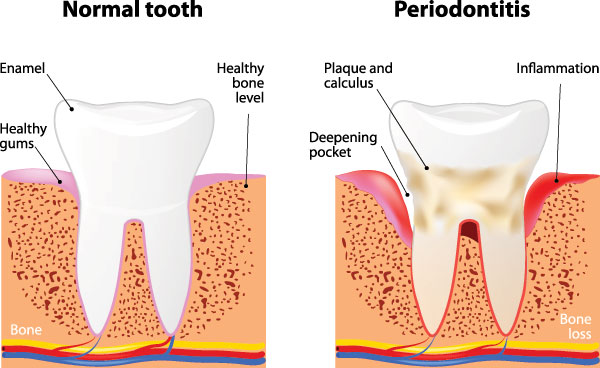 The image shows a diagrammatic representation of the process of tooth decay, with different stages labeled as  normal,   periodontitis,  and  bone loss.  It illustrates how healthy gums transition into inflamed and diseased gums, leading to bone resorption around the teeth.