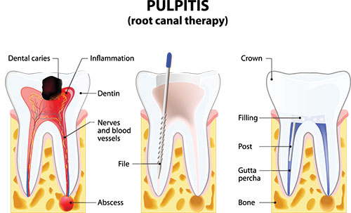 The image is a medical diagram illustrating the process of pulpitis, showing the affected tooth with inflammation and a needle inserted into the pulp cavity.