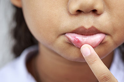 The image depicts a young child with a noticeable skin condition, specifically an acne-like rash or pimple on the chin area. The child is holding their chin with one hand and appears to be inspecting or touching the affected skin.