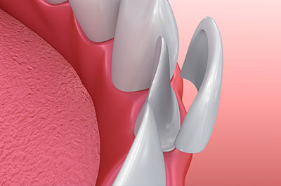 The image shows a close-up of a dental implant with an abutment and screw, set against a pink background that resembles gum tissue.