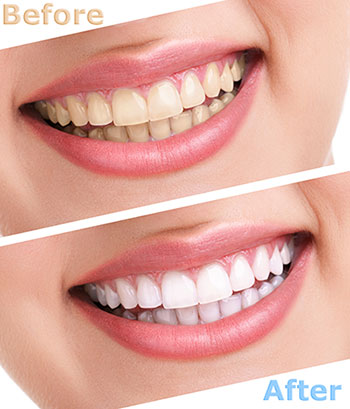 The image shows a before-and-after comparison of teeth whitening, with the  before  showing stained teeth and the  after  displaying significantly brighter, cleaner teeth.