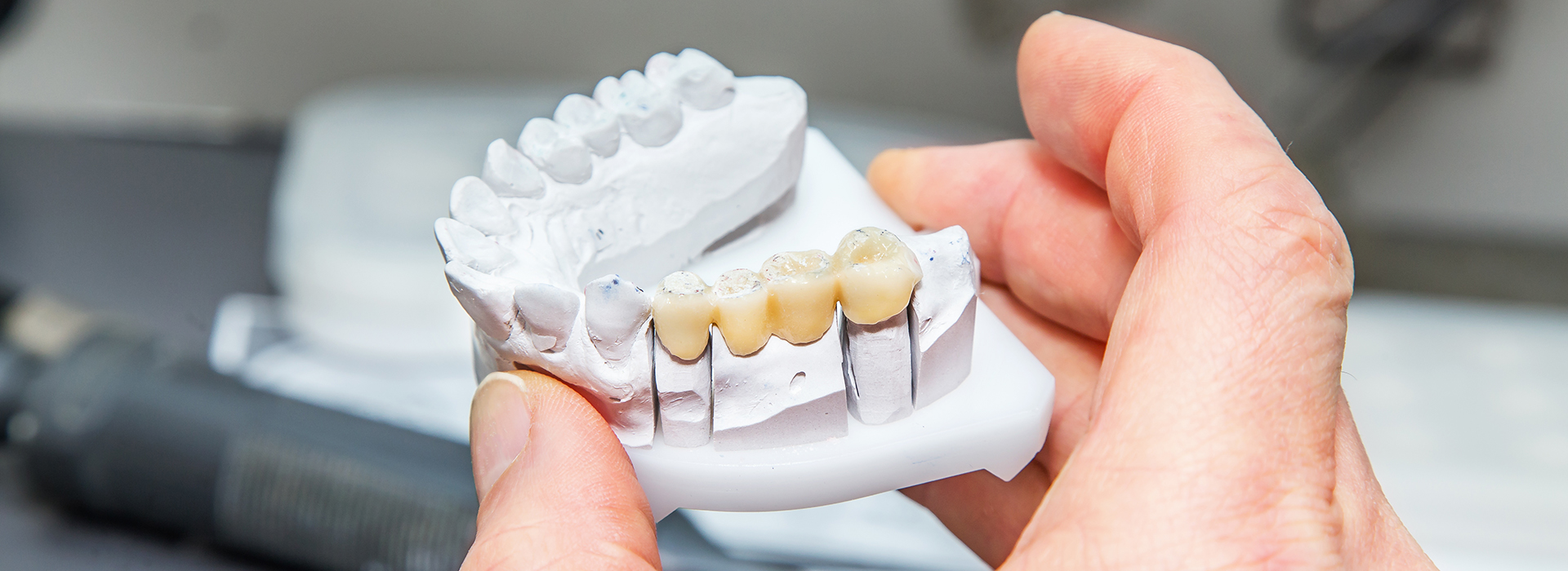 The image shows a person s hand holding a 3D printed dental implant model, with the model showing teeth and gum structures.