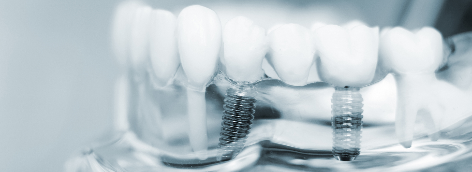 Close-up of a transparent dental mold with tooth impressions.