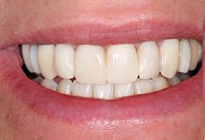 The image shows a close-up of a person s smiling face with straight, white teeth and pink gums.