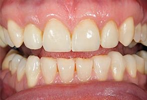 Image of a person s mouth with teeth showing, featuring yellowish-brown stains and a partial view of the lower lip.