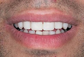 The image is a close-up photograph of a person s mouth with teeth, showing a smile with the teeth visible and the lips slightly parted.