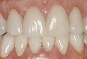 The image shows a close-up of a person s teeth with a focus on the bottom row, which appears to be in need of dental care.