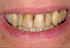 The image displays a person s mouth with yellowed teeth and a dental implant, showing a smile with the teeth in focus.