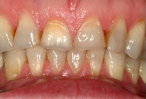 The image shows a close-up of a person s teeth with visible staining and discoloration, indicating the need for dental care or treatment.